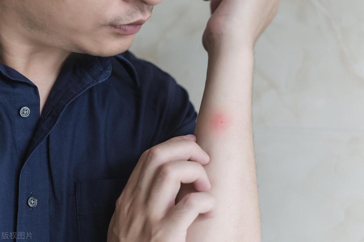 突发汗疱疹怎么办,如何缓解汗疱疹的灼热