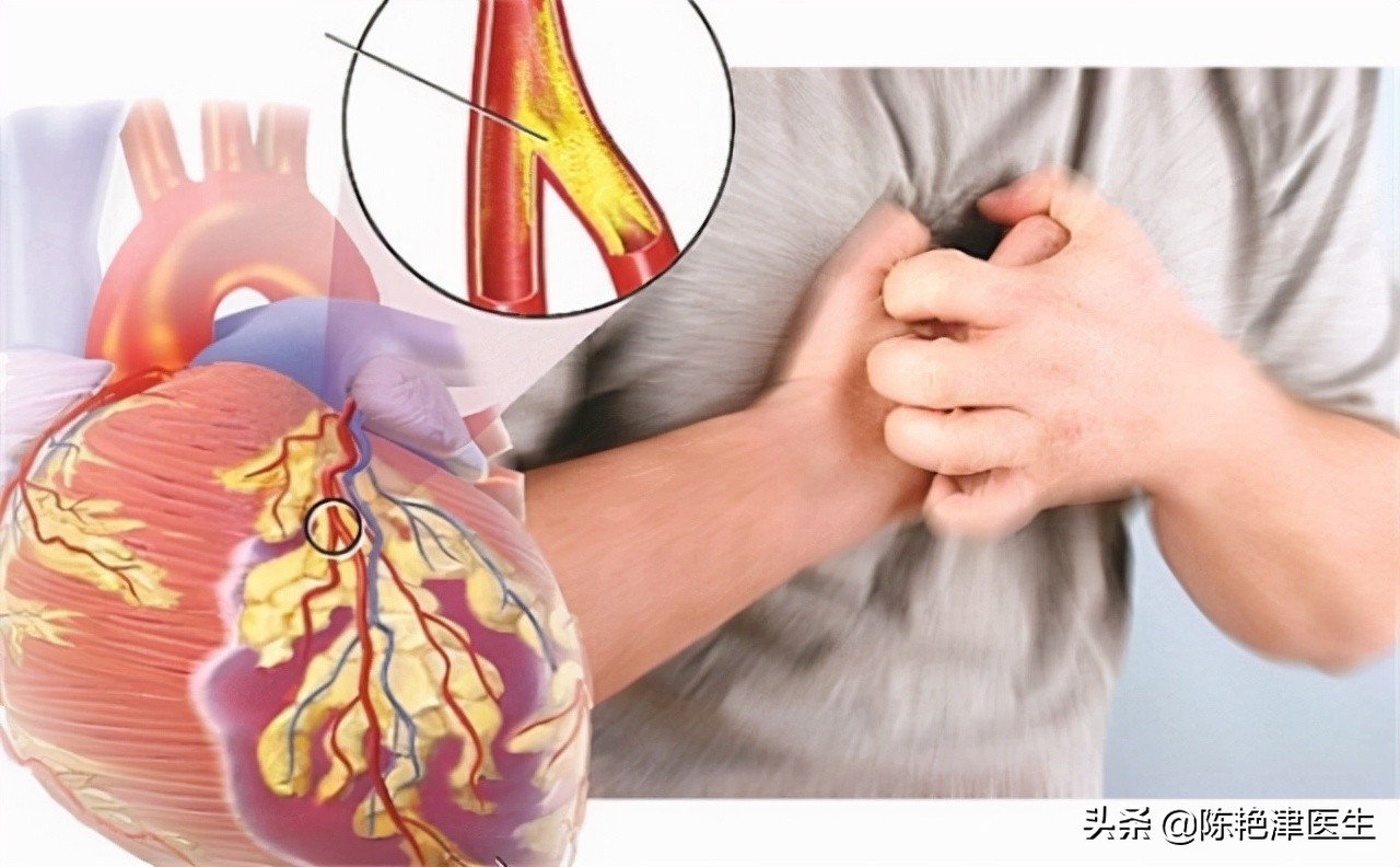 55岁大叔斑块消失，他长期坚持3个“护血管”方法，行之有效