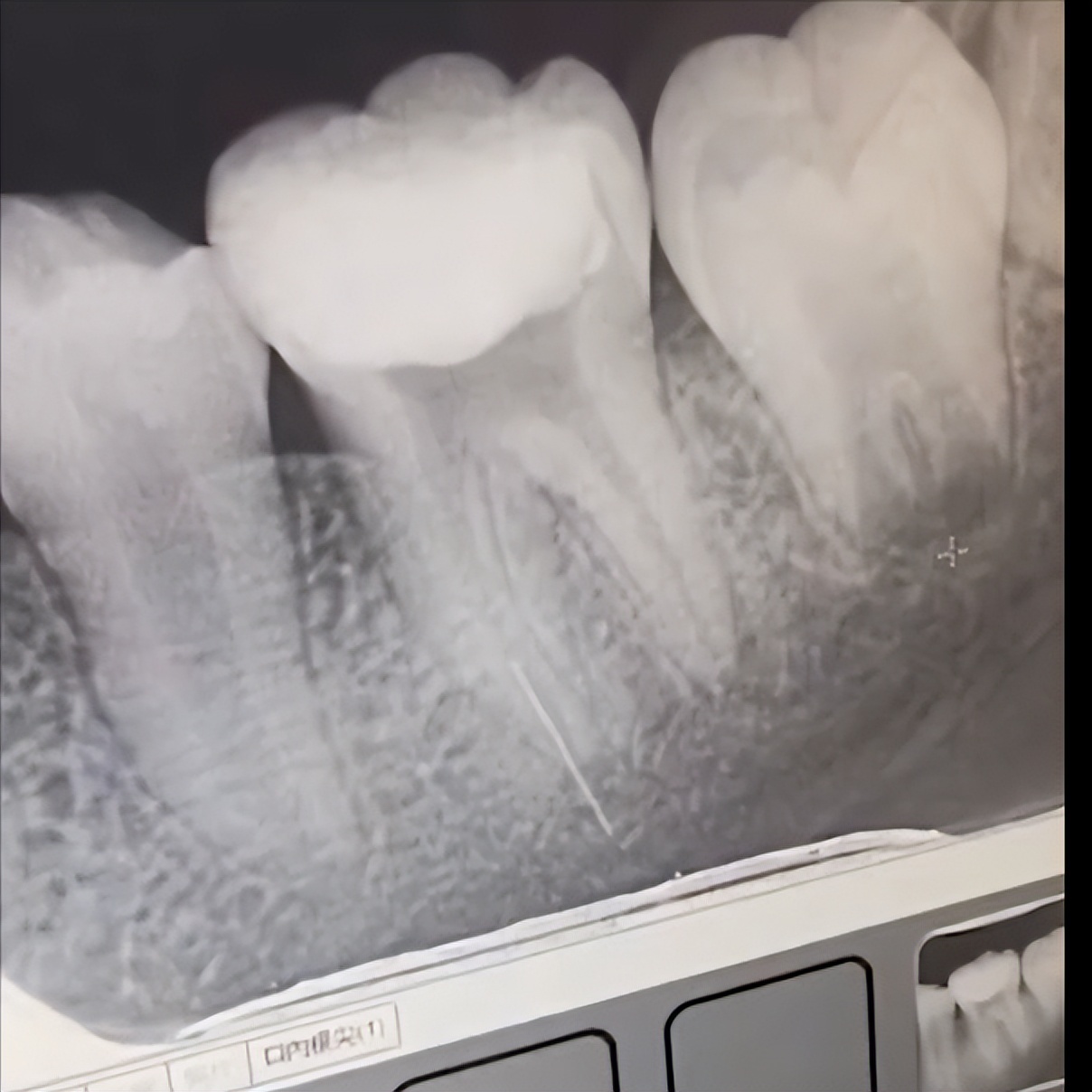 做根管治疗期间牙齿劈了,做根管治疗的牙断了一部分