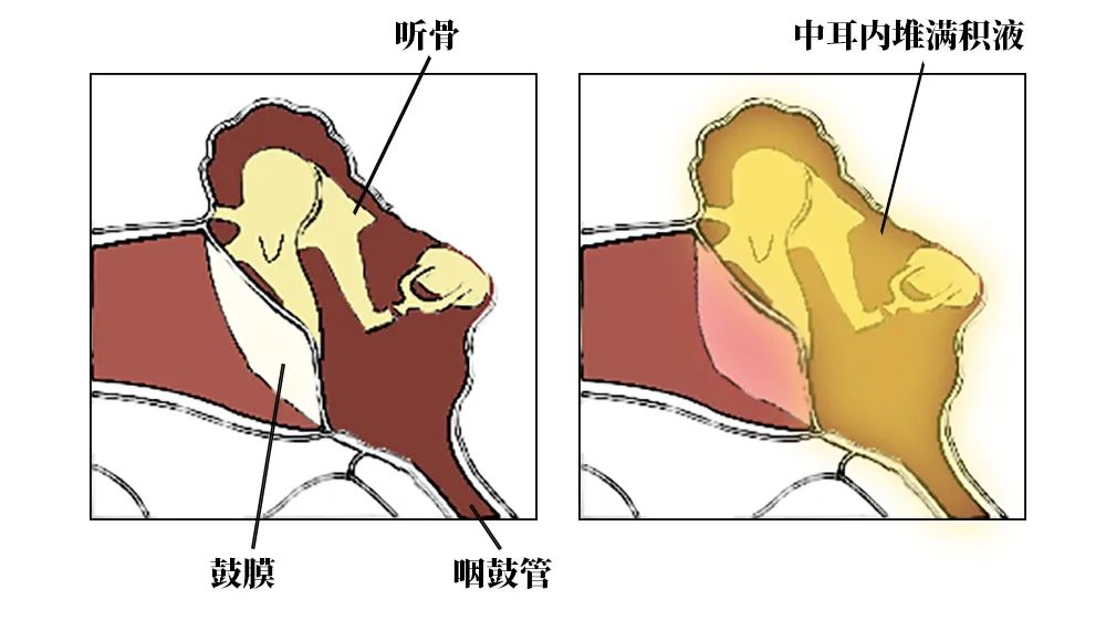 二阳后耳聋,二阳后耳聋能自愈吗