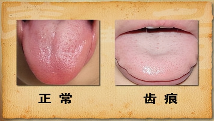 舌头有齿痕,又有裂纹,是怎么回事?3味药泡水喝,祛湿补肾养阴