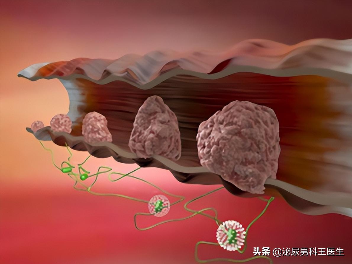 直肠癌早期身体发出3个救命信号,直肠癌症状是先下坠还是便血