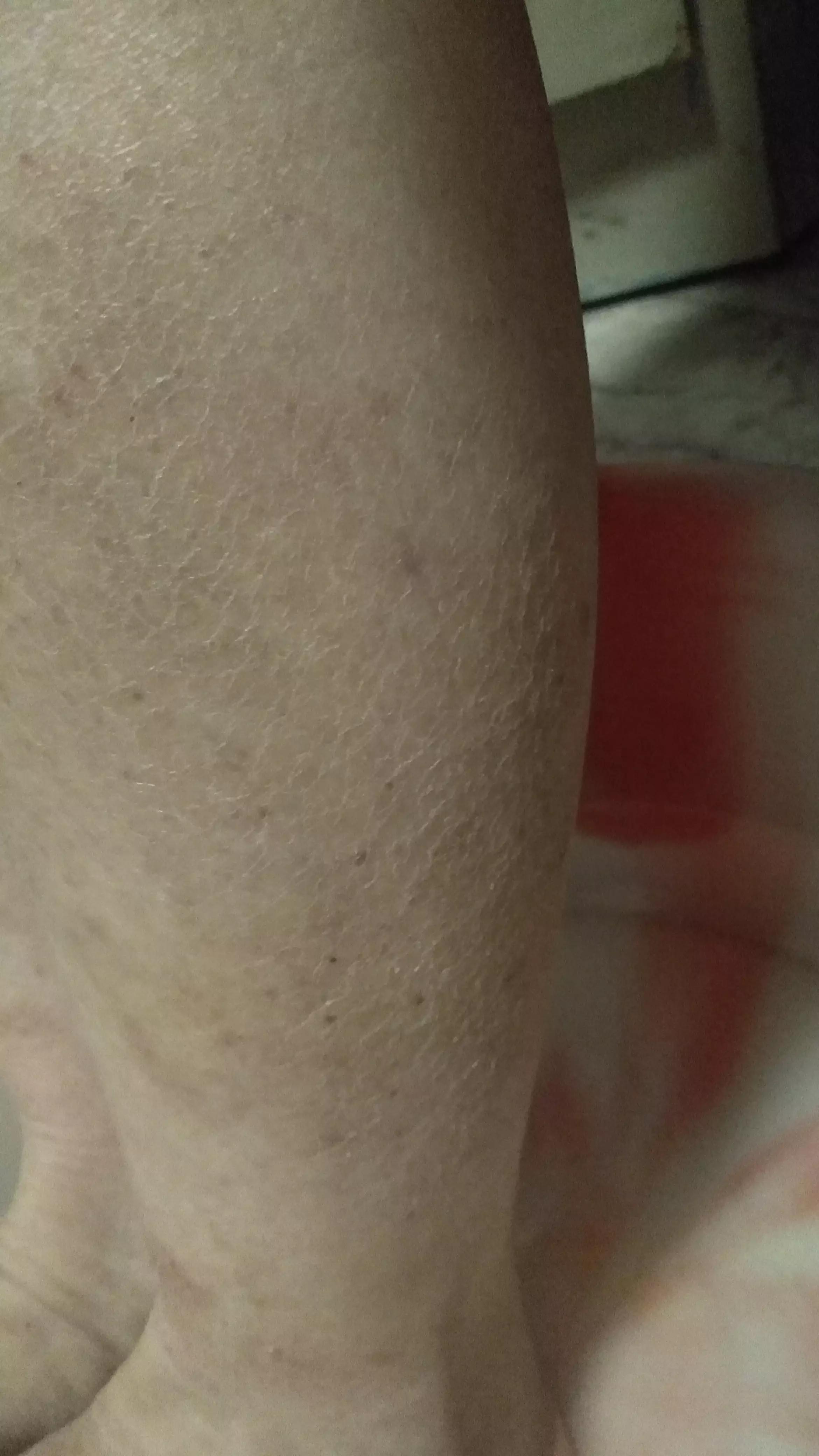 我多年的湿疹终于治好了,我湿疹怎么是一圈一圈的