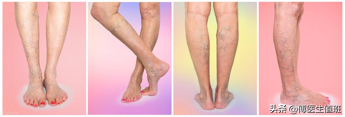 小腿色素沉着溃烂最佳解决方法,小腿静脉皮肤色素沉着溃烂怎么办