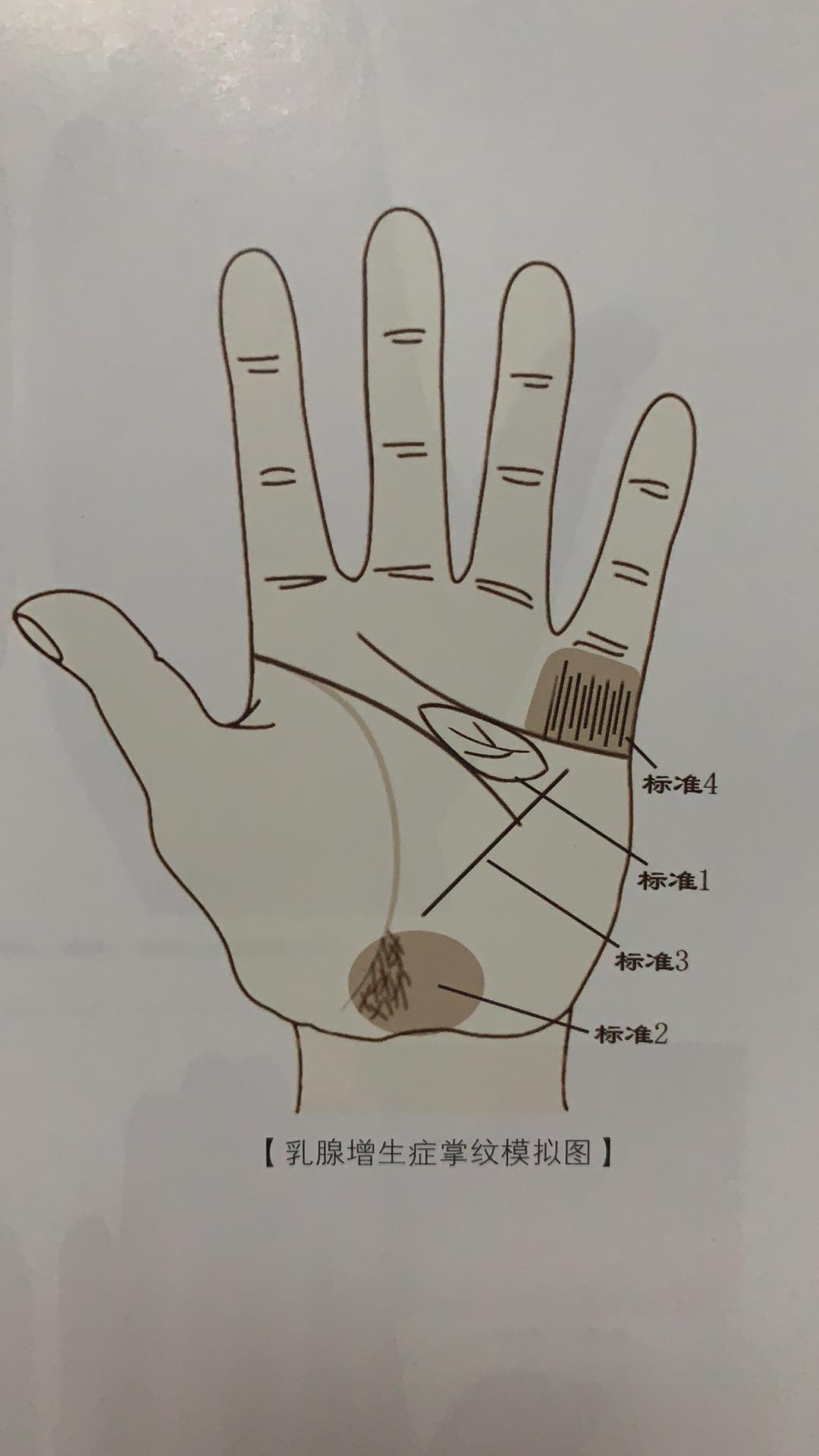 《伤寒论》里的千古名方：小柴胡汤，妙用可治甲状腺、乳腺结节