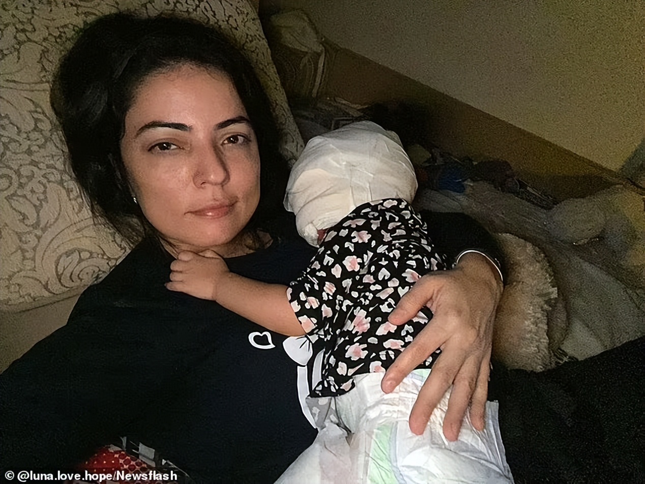 美国小女孩脸带“蝙蝠侠”黑印,治疗两年经过终于恢复肉色!