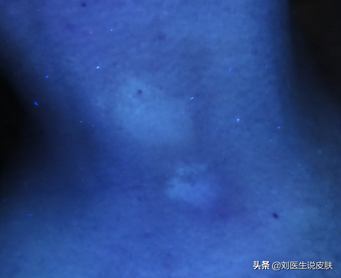 中年男人脖子上长了一个疣,中年男人脖子上出红斑