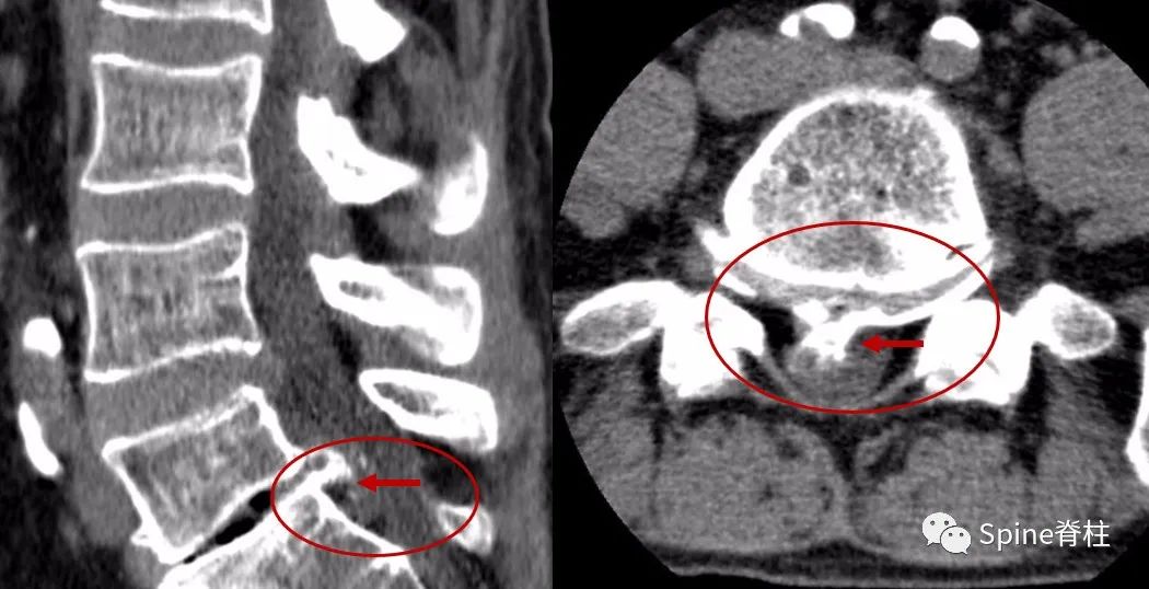 腰椎间盘突出症的治疗方法,腰椎间盘突出症状主要有哪些