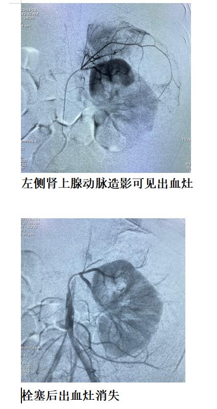 肾上腺肿瘤的介入栓塞治疗,肾上腺恶性肿瘤介入治疗
