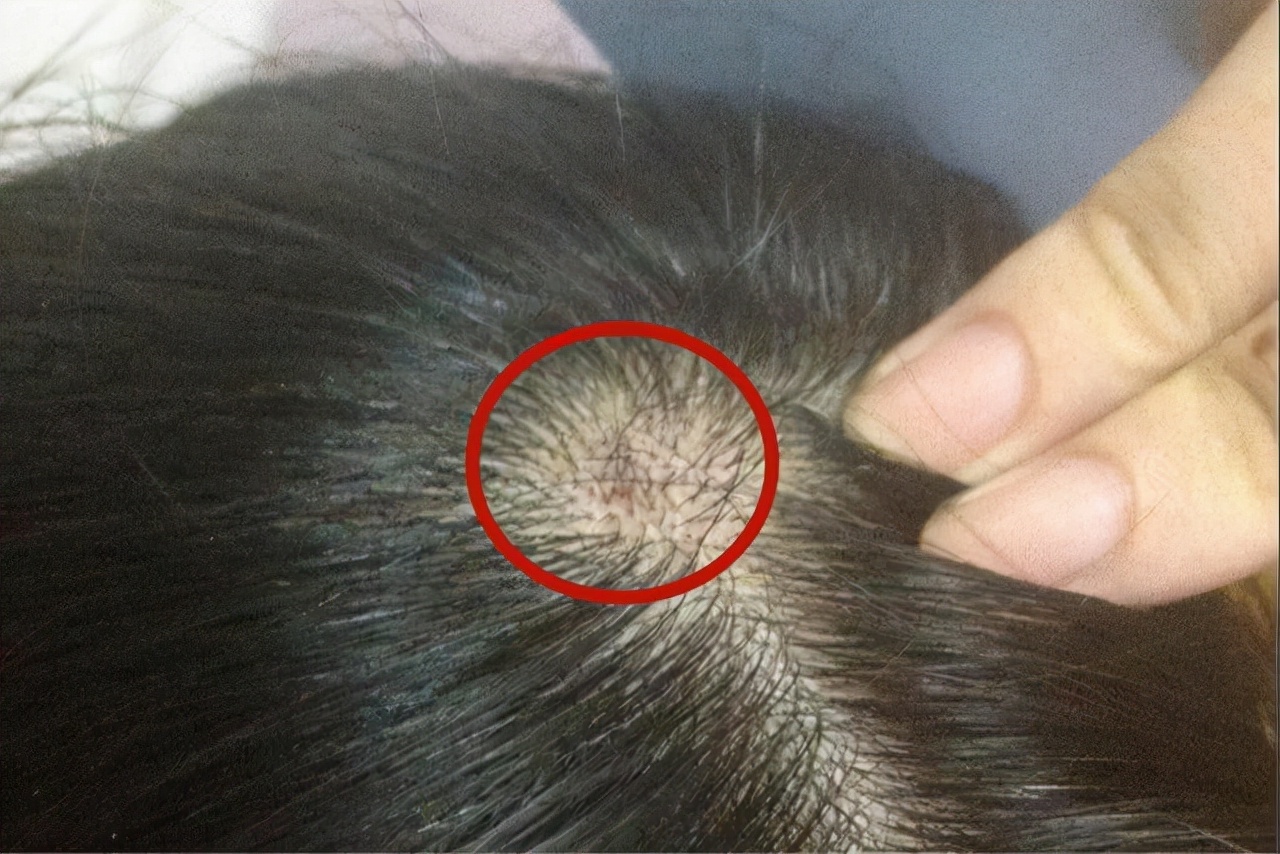 头皮上总出油长有疙瘩或脓包,头皮总是长疙瘩或脓包是什么原因