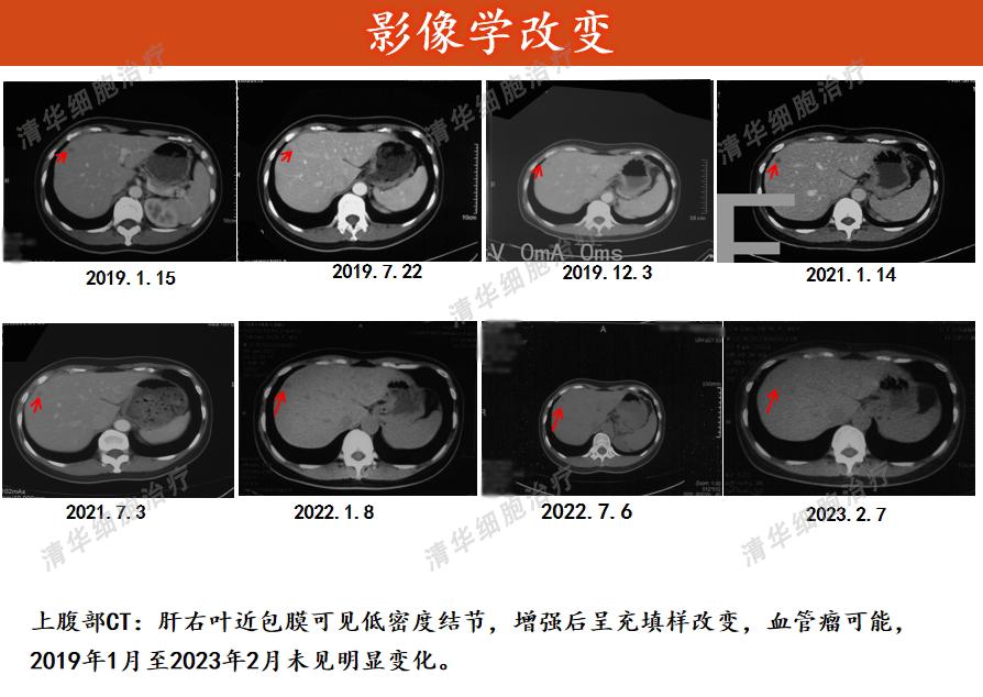肉瘤领域的免疫疗法新策略,肉瘤免疫治疗的费用