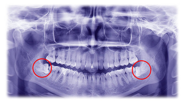 年底牙疼怎么办,春季牙疼是什么原因
