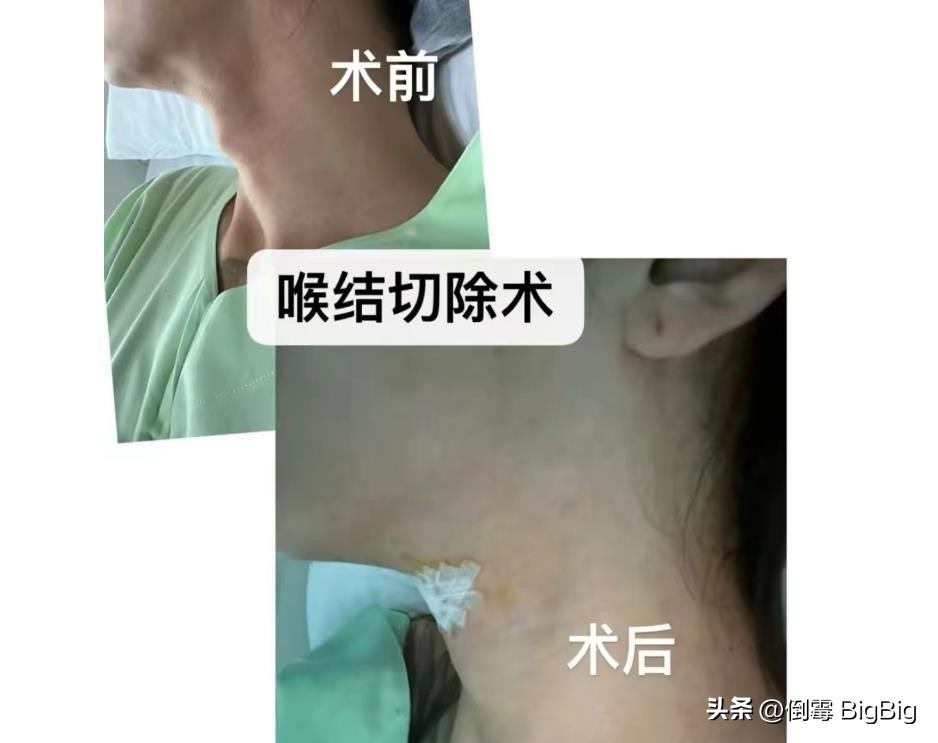 泰国做变性手术网红,泰国做了变性手术成明星了