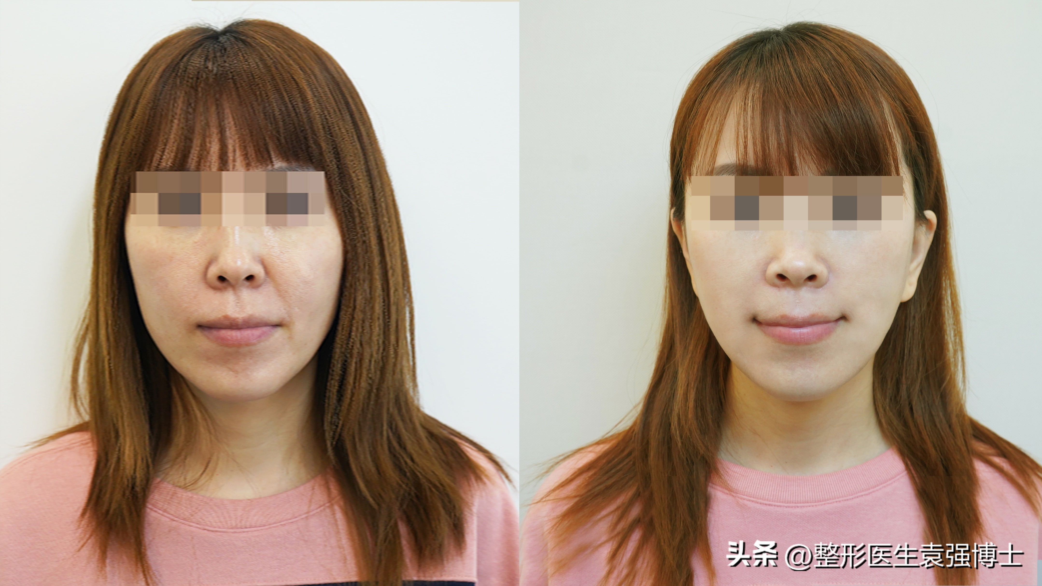 有法令纹千万不要做这三件事,年纪轻轻就有法令纹该怎样去解决