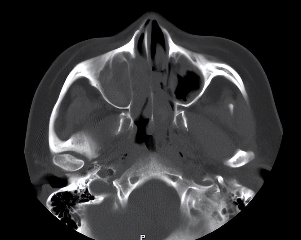 嗜酸性粒细胞性鼻息肉容易复发吗,鼻息肉手术后6个月复发怎么处理