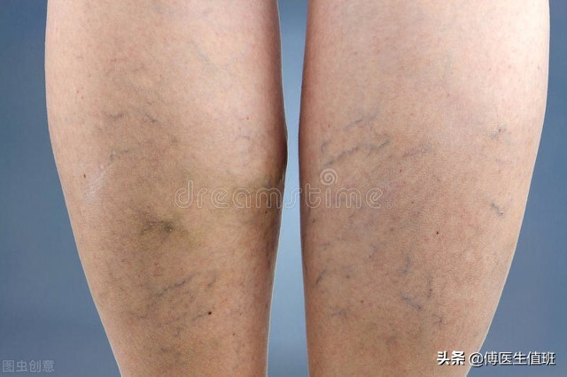 小腿色素沉着溃烂最佳解决方法,小腿静脉皮肤色素沉着溃烂怎么办