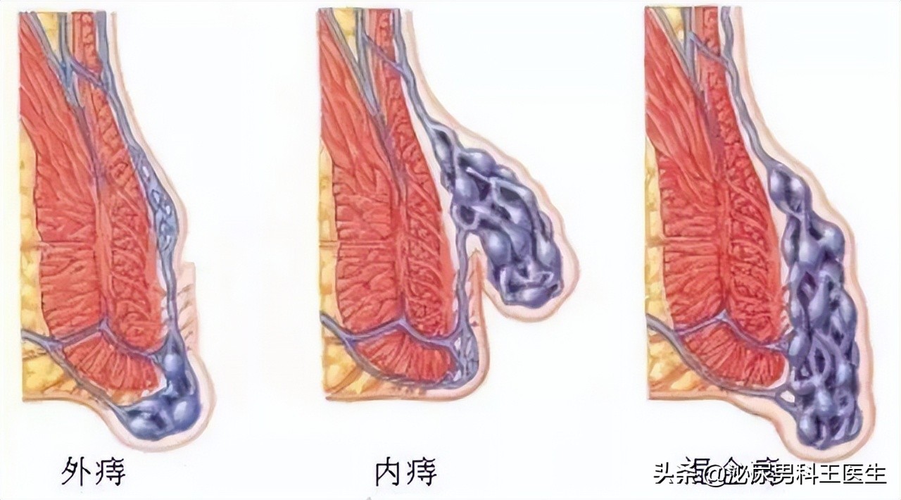 “难以启齿”的肛管癌，你了解它吗？出现3个症状，及时就医检查
