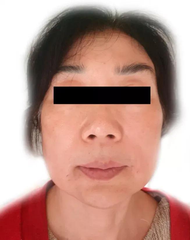 精准注射：如何用更少剂量肉毒毒素处理眉间纹？