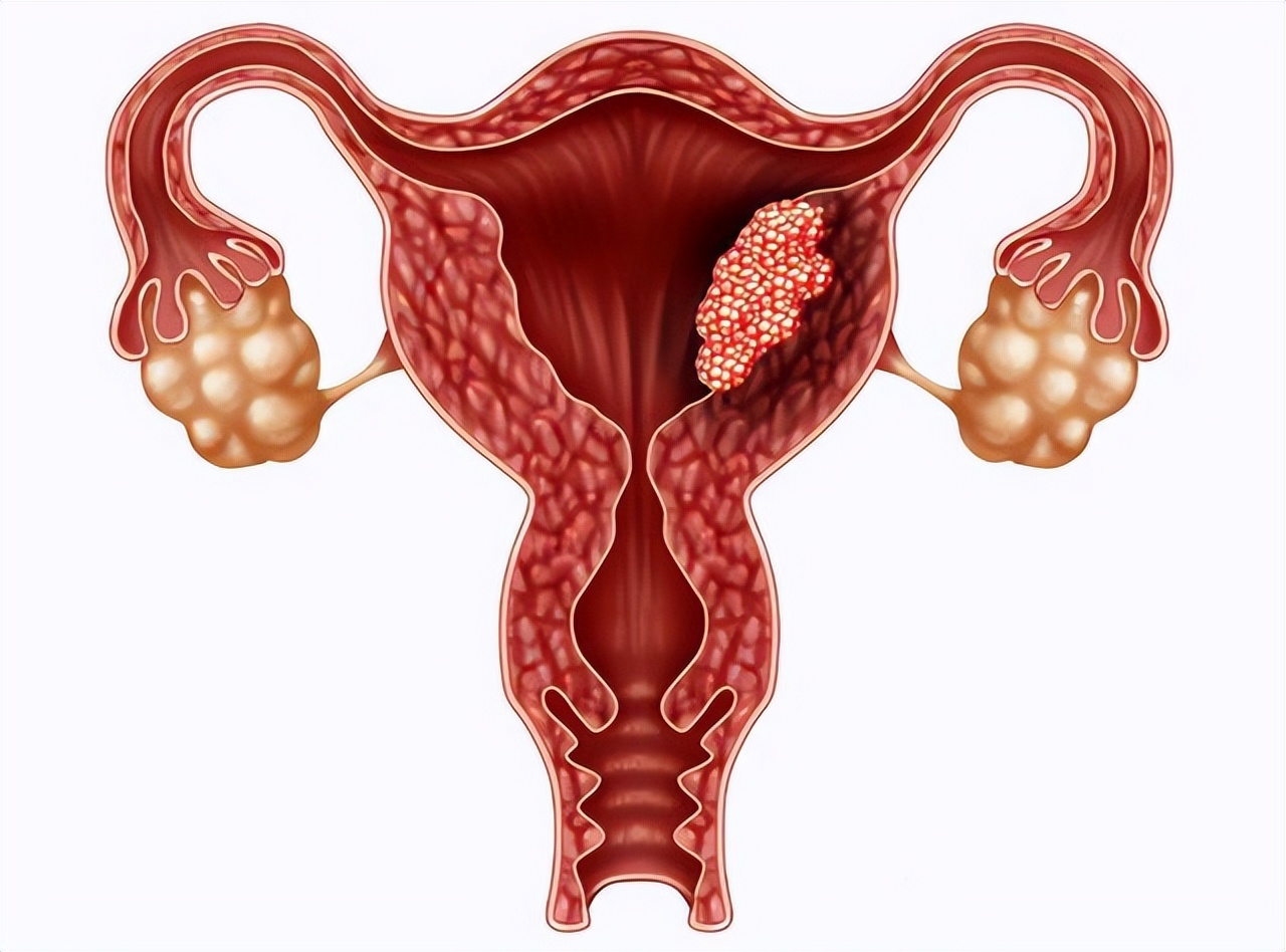 宫颈癌来的时候会出现什么症状,宫颈癌的哪8种症状表现最严重
