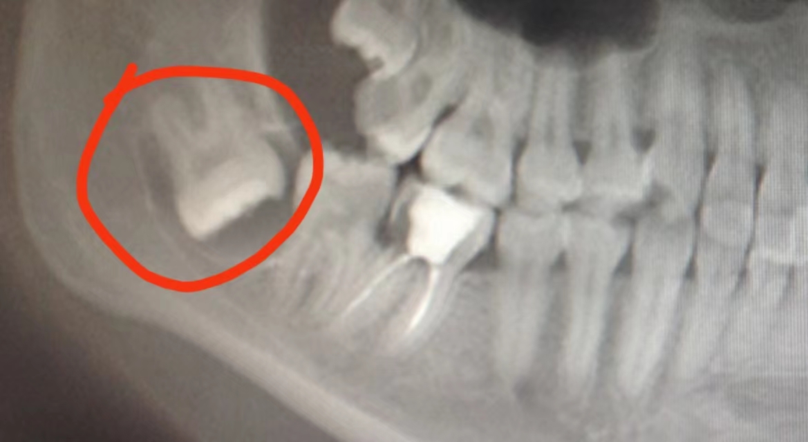 骨性凸牙可以做正颌手术吗,颌骨重建隐形矫正