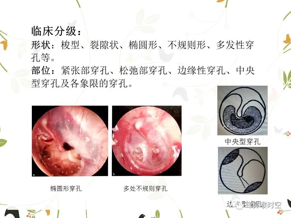 鼓膜可见穿孔,鼓膜穿孔听力下降能恢复吗