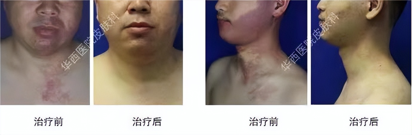 孩子身上长了黑的胎记会不会癌变,检查宝宝有没有胎记