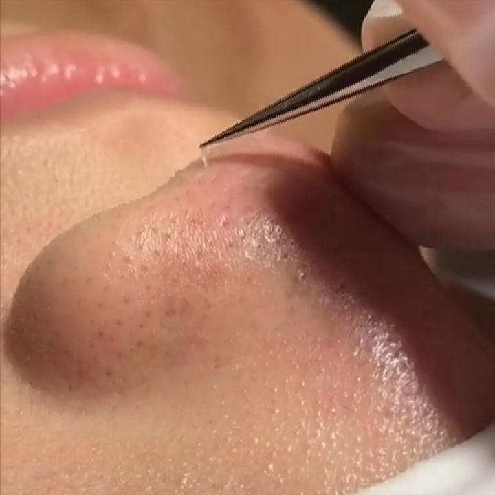 鼻子上有白白的小点可以挤吗,鼻子上黑黑的小点点怎么去除