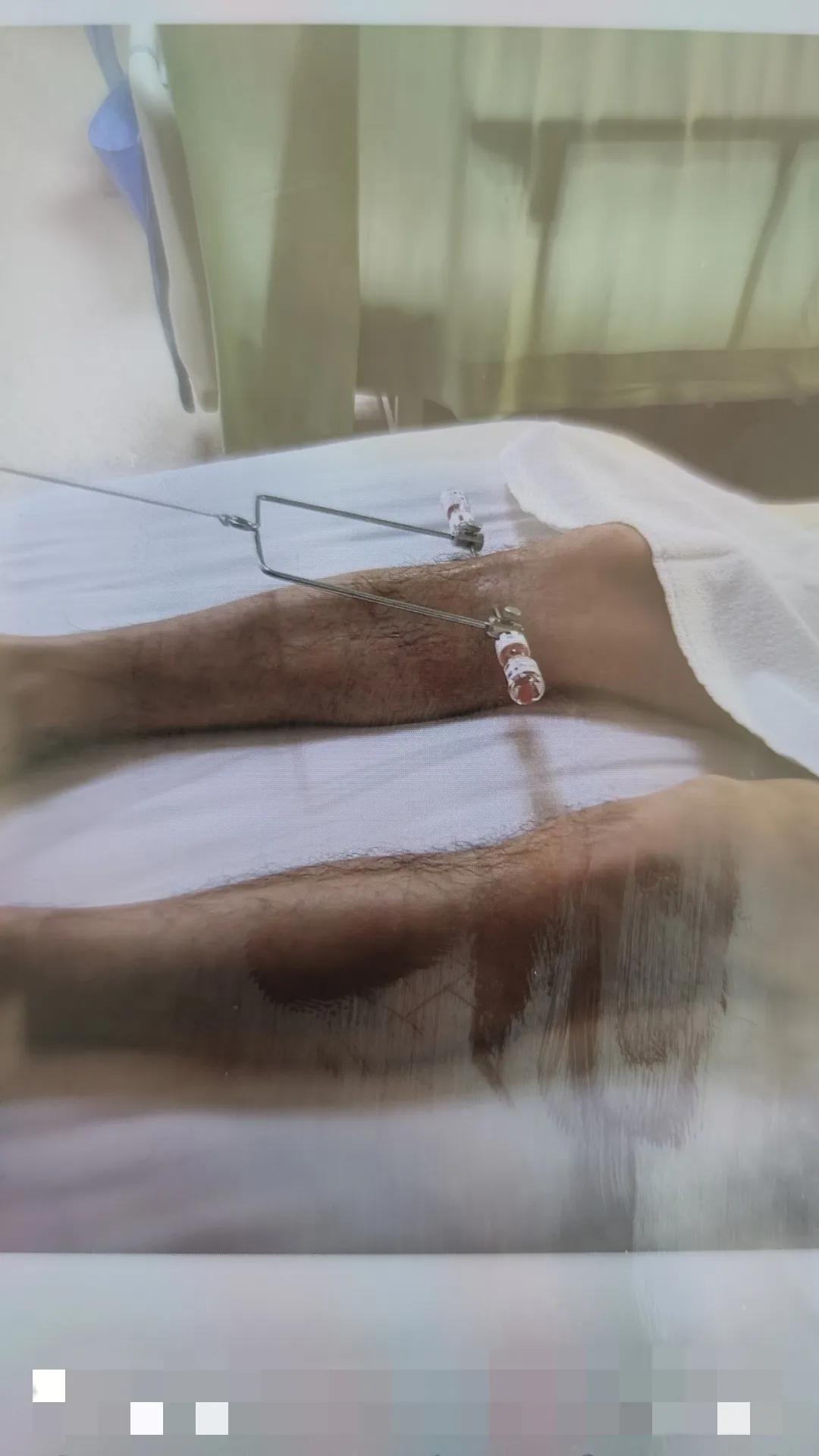 股骨颈骨折康复治疗,股骨颈骨折内固定康复