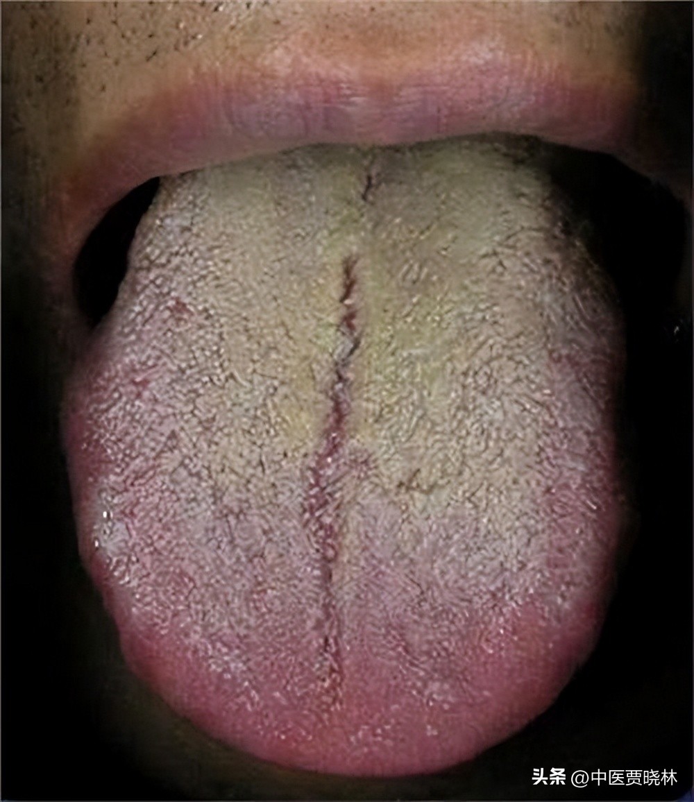 胃炎用奥美拉唑老不好？分享4个中成药，横扫胃痛，胃胀，胃酸