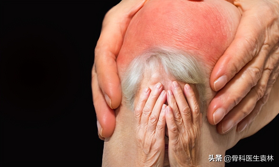 肥胖与骨关节疾病的关系,肥胖引起的关节炎怎么治