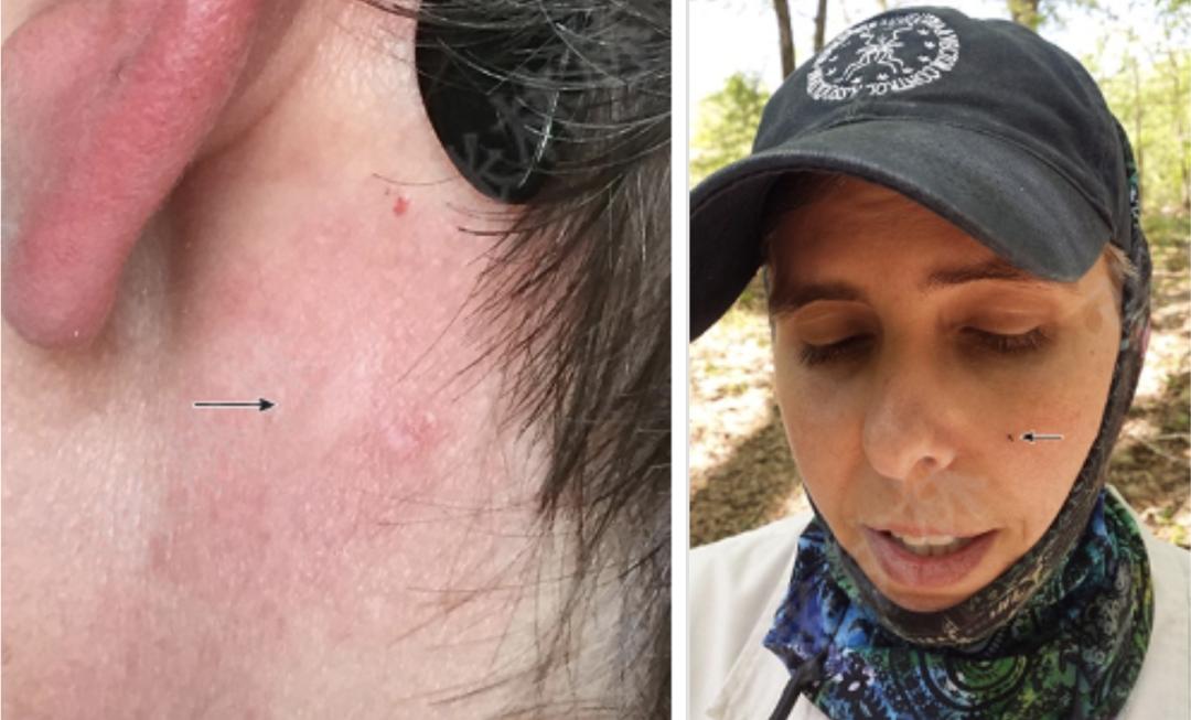 带娃出门游遇到蜱虫千万别乱拔,警惕这三种毒虫带娃出行必看