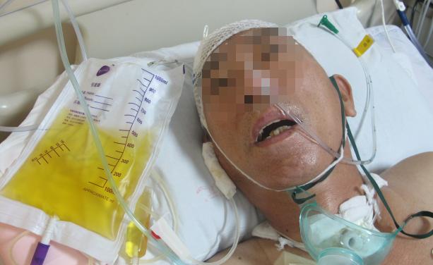 前交通动脉瘤破裂后开颅治疗风险,脑前交通动脉瘤破裂出血