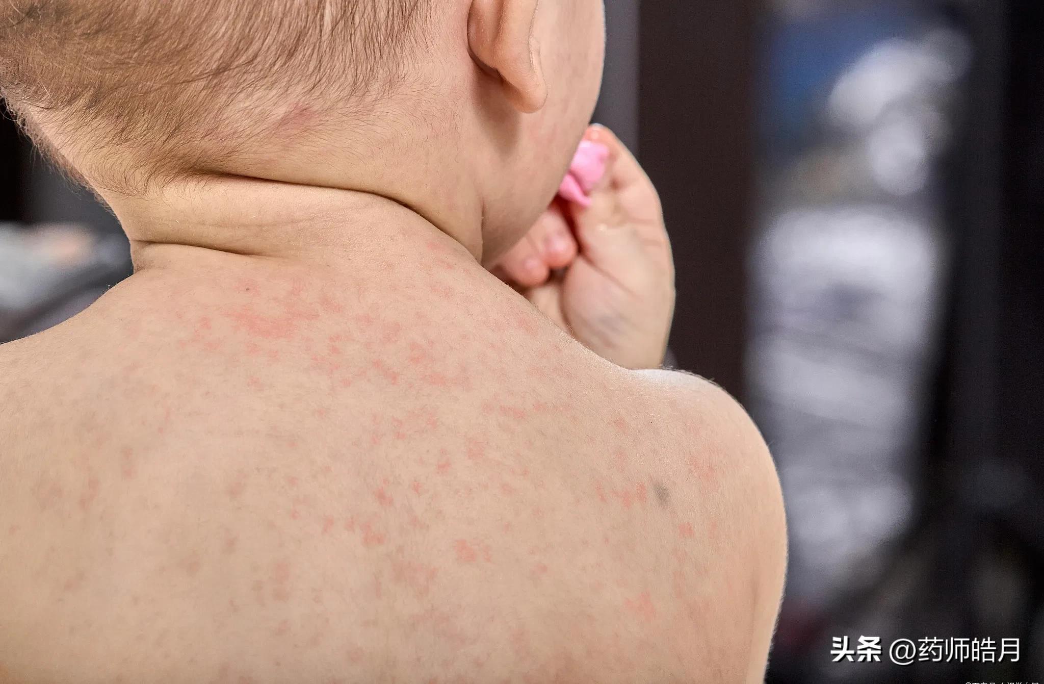 手背长湿疹反复发作如何除根,湿疹反复怎么办教你一招去除