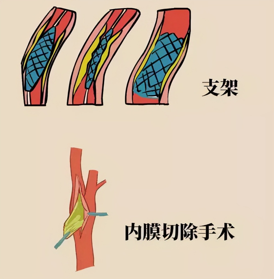 什么是血管成形术,经皮腔内血管成形术的操作过程
