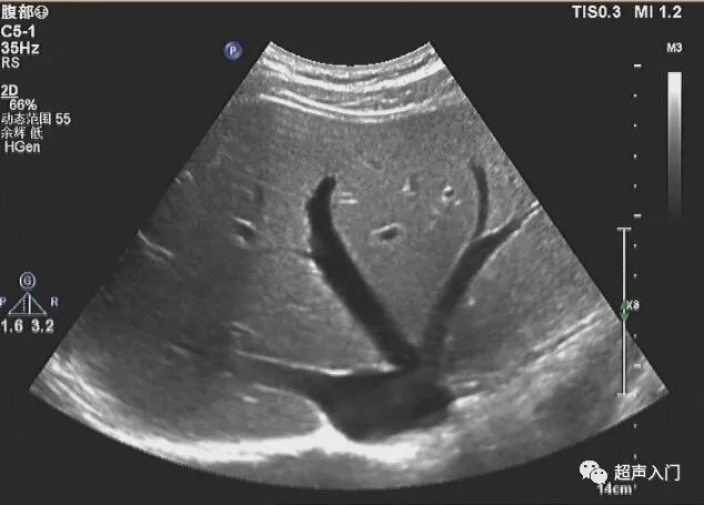 超声学自己能学吗,超声初学者有何窍门