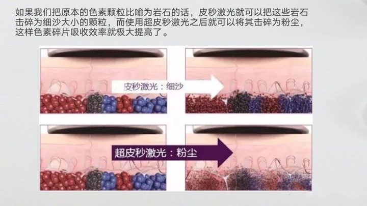 皮秒祛斑个人经历,轻医美祛斑怎么做的