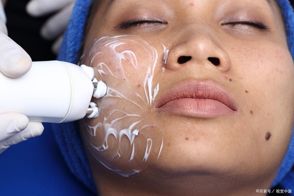 老年斑红霉素可以去除吗,老年斑红霉素