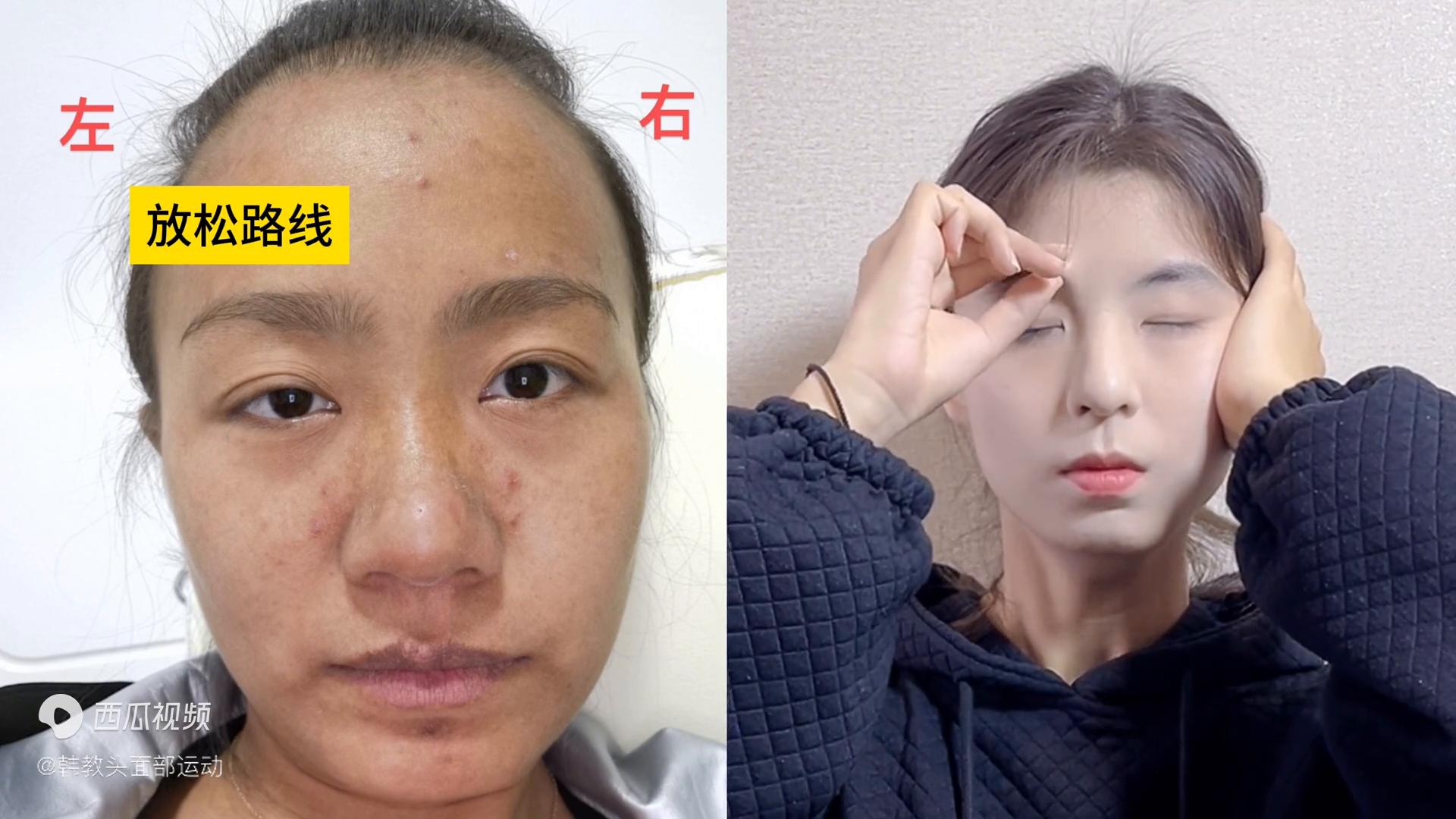 大小脸颧骨一边高一边低矫正,大小脸纠正颧骨突出