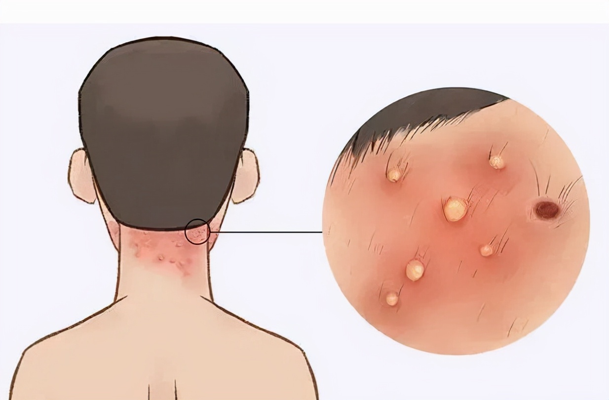 头皮毛囊炎细节视频,头皮毛囊炎的病因你都知道吗