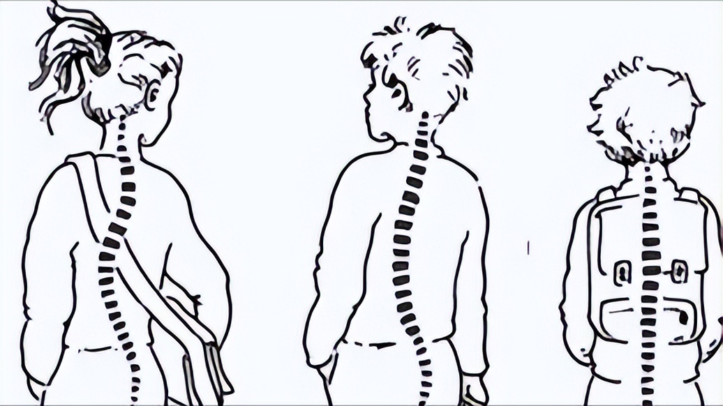 脊柱侧弯的成因、评估及康复