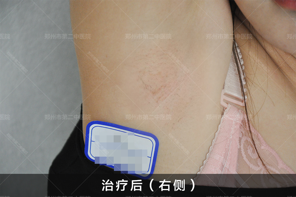河南哪里祛疤痕比较好,河南哪家医院祛疤最好