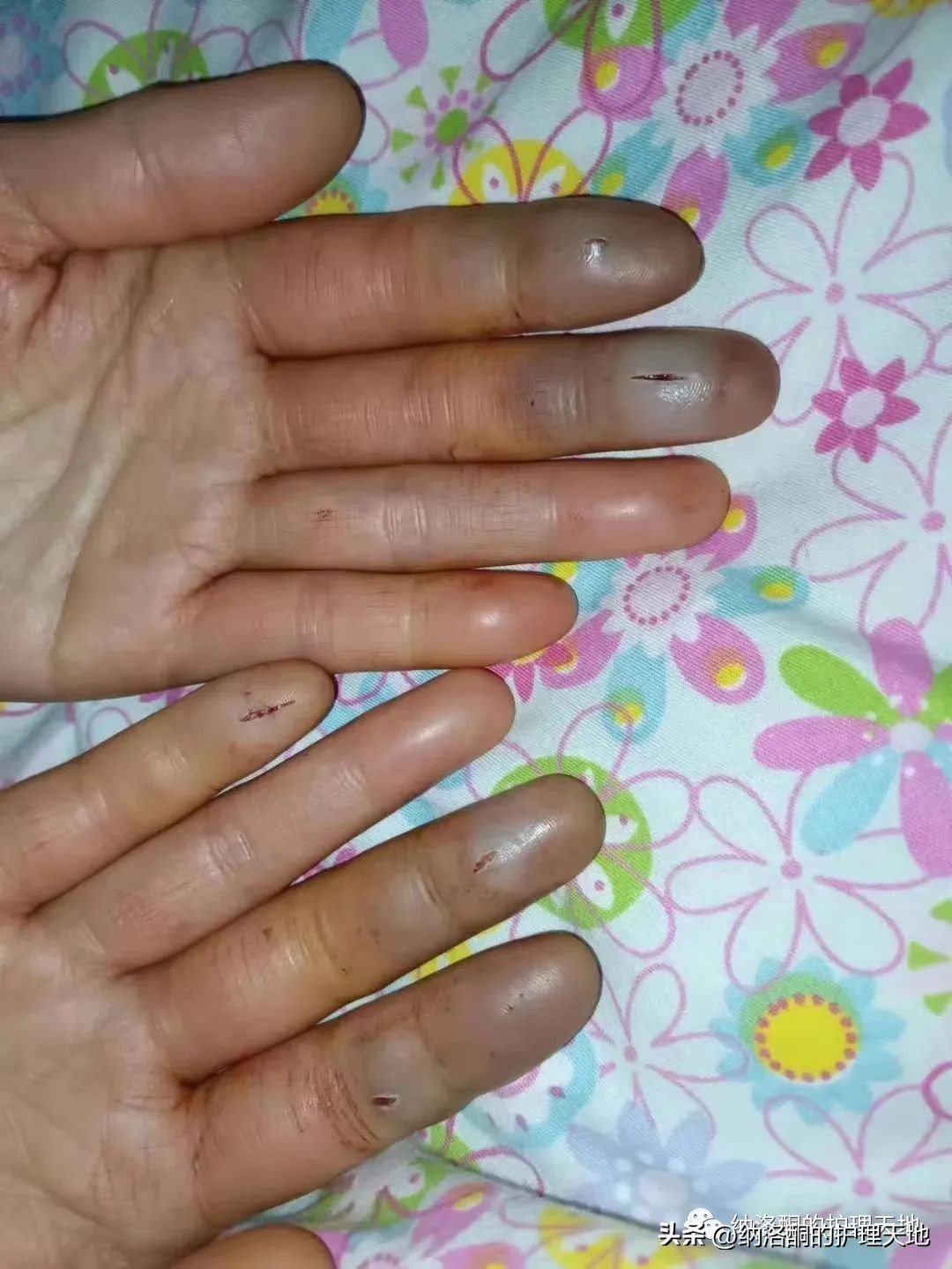 手指轻微低温冻伤的急救方法,三度冻伤应由医生处理吗