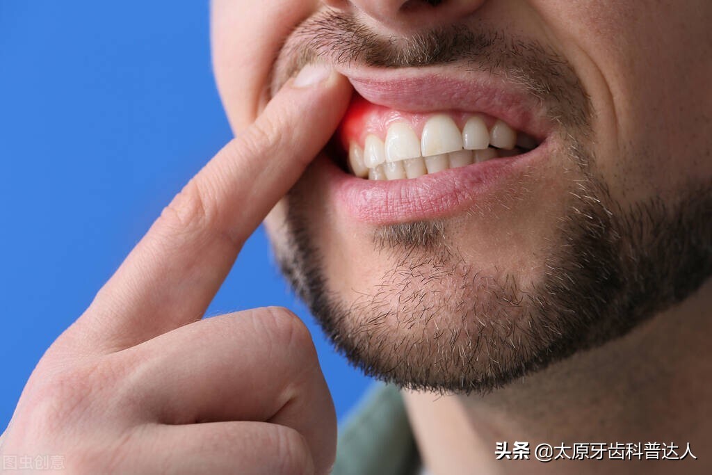 上火牙龈出血怎么治疗最有效,上火口腔牙龈出血缺什么
