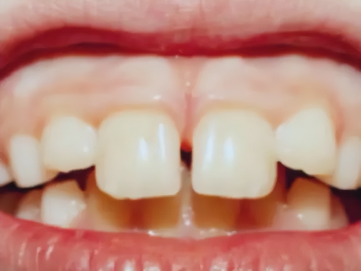 孩子口腔问题家长一定要重视,宝宝吃手口腔疾病