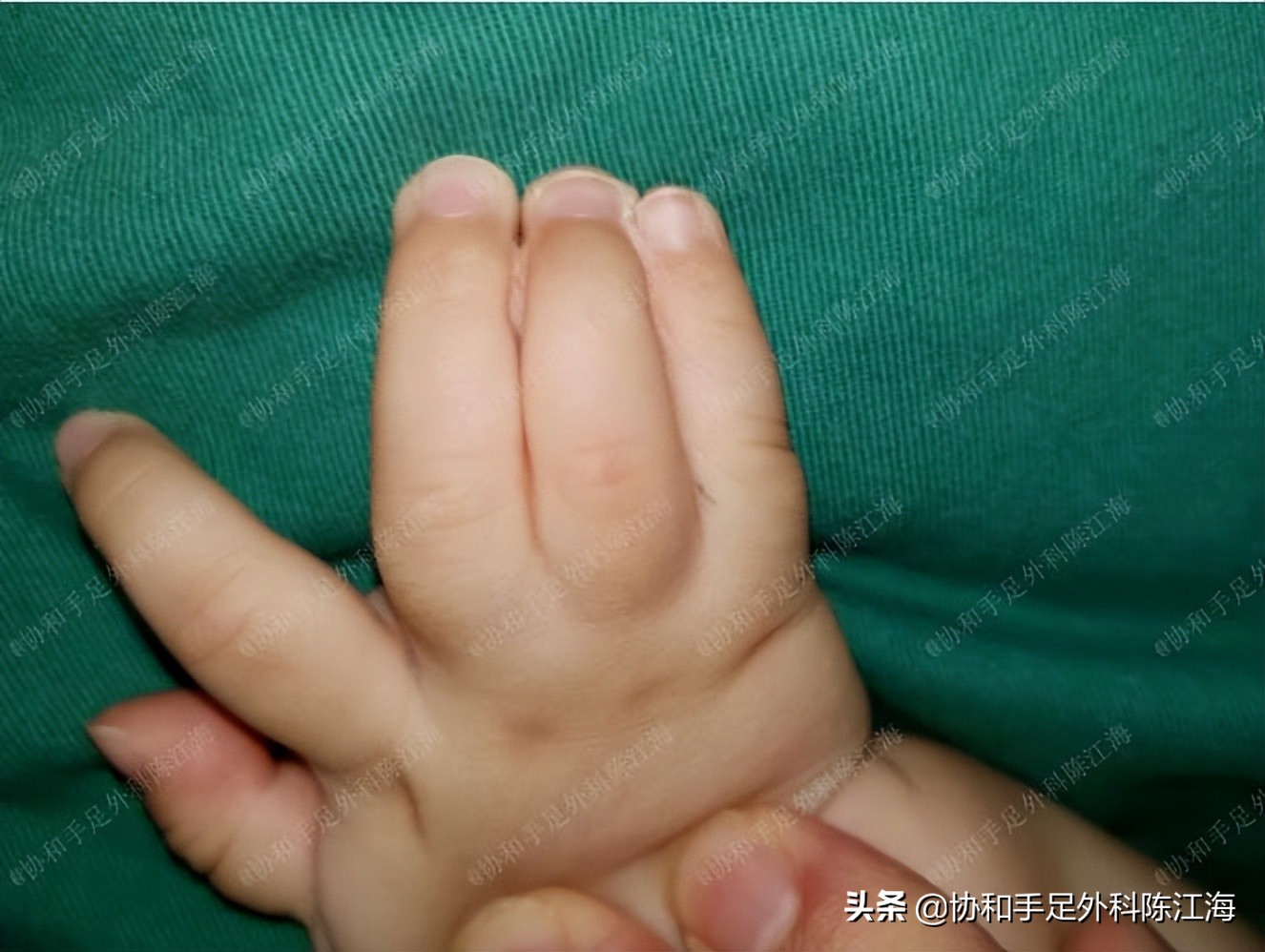 孩子四肢粘连,手脚粘连的婴儿