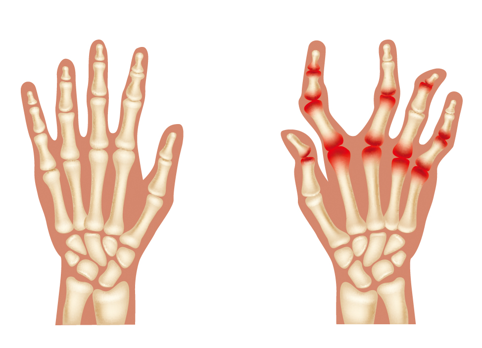 类风湿性关节炎是什么因素引起的,类风湿性关节炎的得病因素有哪些