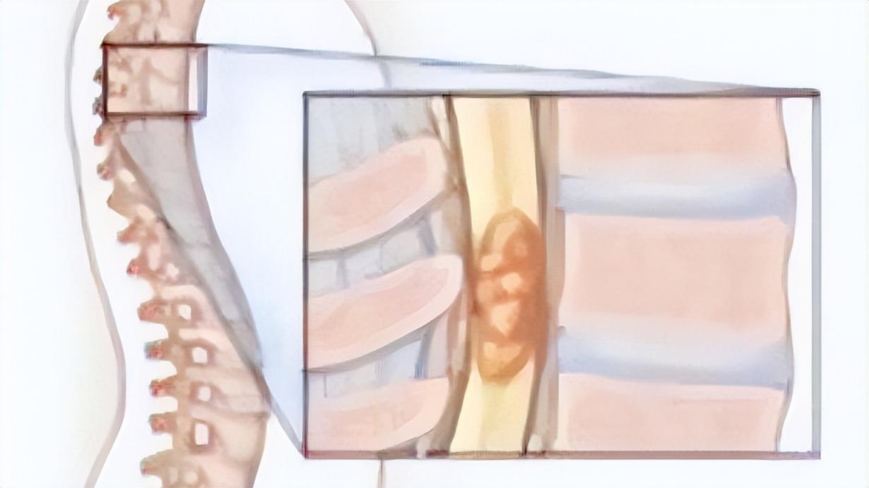 有癌腰痛是什么症状,体内有癌腰部先知