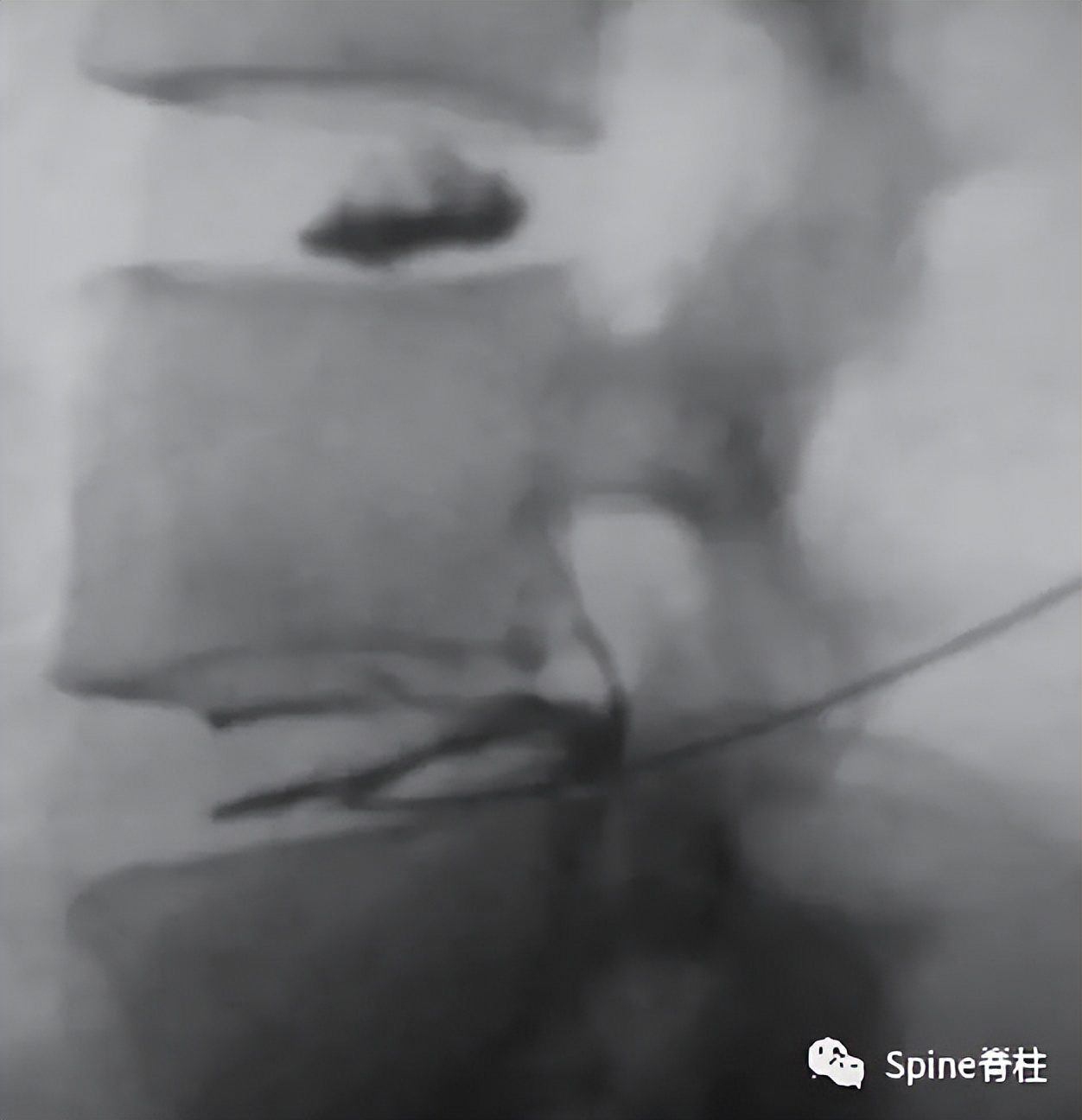 因腰椎问题导致的腰痛,慢性腰骶部疼痛