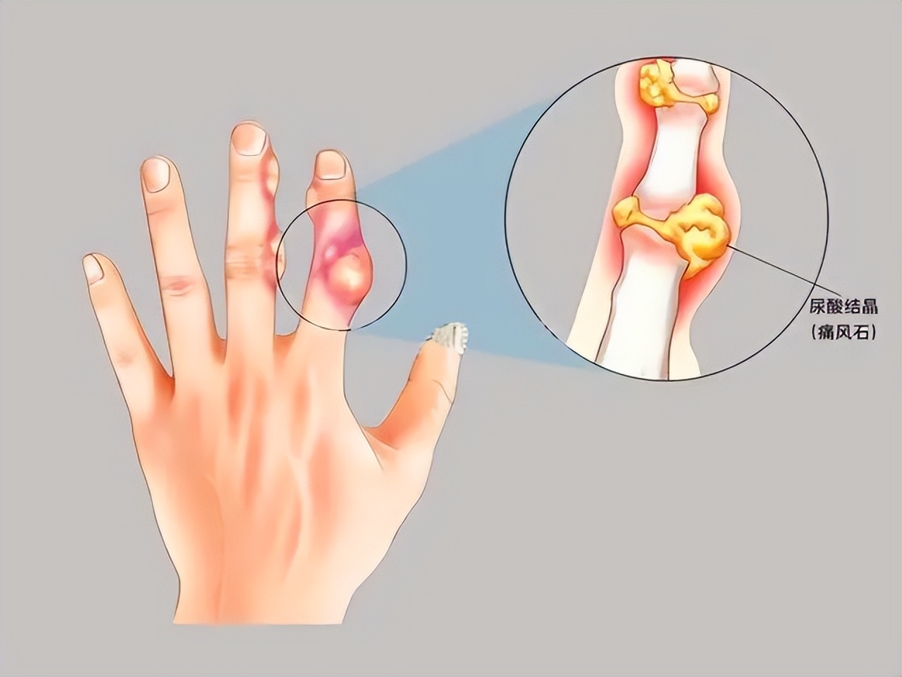 发现手指关节疼是什么原因引起的,手指关节痛是什么原因怎么办呢
