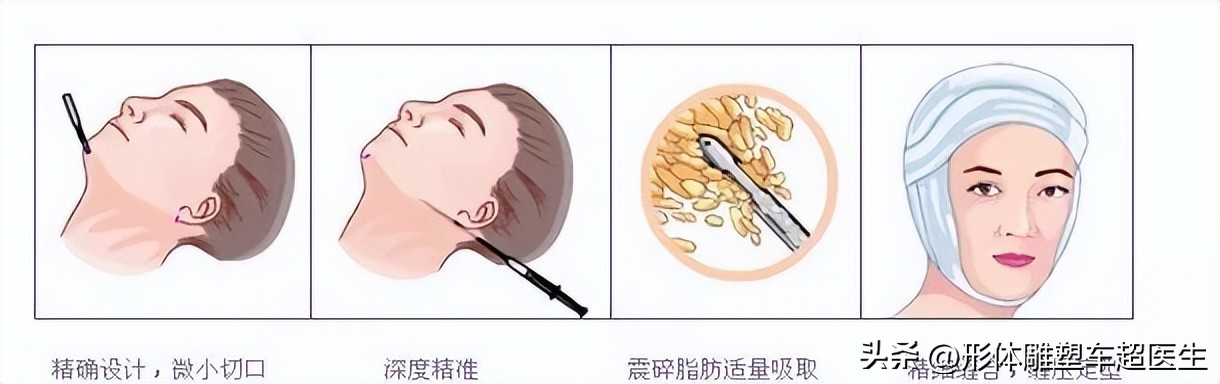 面部吸脂瘦脸效果能维持一辈子,面部吸脂手术的原理